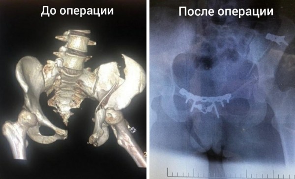 со здоровьем Астраханские врачи вернули возможность ходить девушке, пострадавшей в жутком ДТП